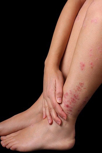 Psoriasis