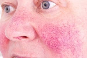 Rosy Complexion? Flushed Cheeks? You May Have Rosacea