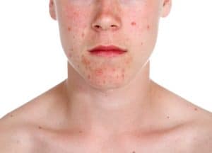 Teenager with Acne