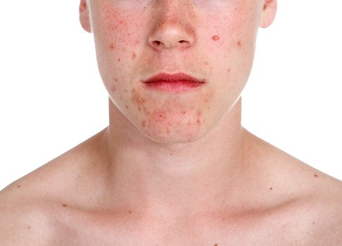 Teenage Acne