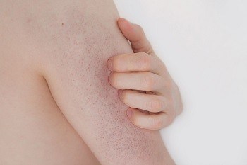 Learn about Keratosis Pilaris