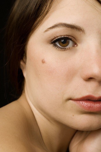 Girl With Moles