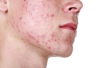 Are You Dealing With severe Acne