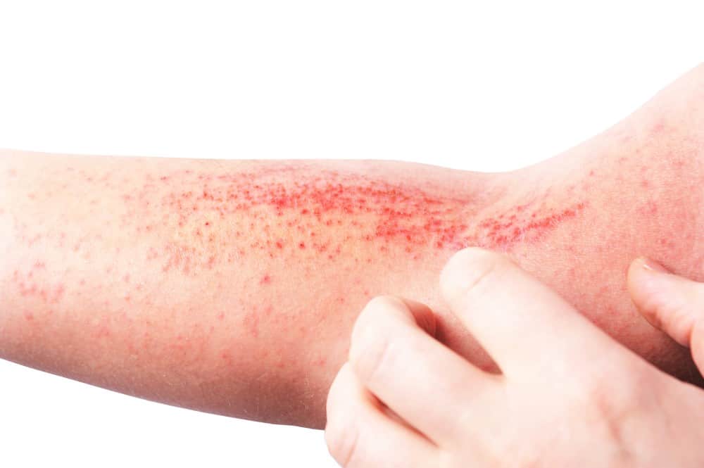 What Is Dermatitis