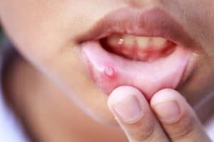 Canker Sore