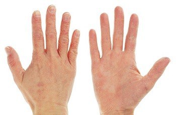 Dealing With Eczema