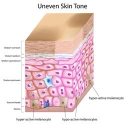 Irregular Skin Pigmentation