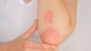 Dealing With Psoriasis