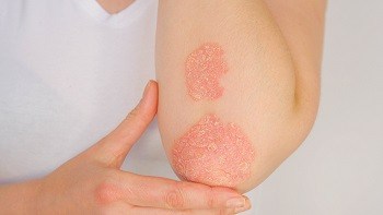 Dealing With Psoriasis