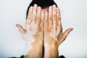 Treating Vitiligo