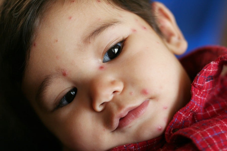 chicken pox