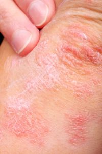 What is Psoriasis