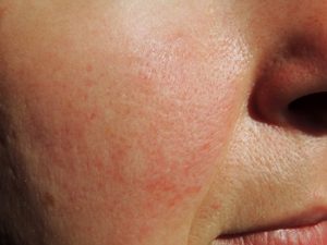 What is Rosacea