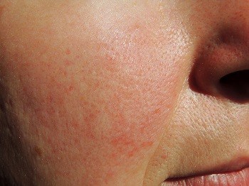 What is Rosacea